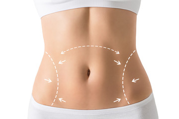 Woman's body marked out for cosmetic surgery. Isolated on white.