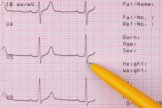 Cardiogram of heart beat