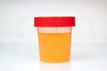 Urine Sample in closed transparent plastic can.