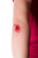 gestreckter Arm, mit Wunde am ellebogen