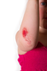 angewinkelter Arm mit Wunde am Ellenbogen