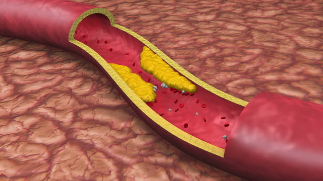 Clogged Artery Low Angle Digital Animation with platelets and cholesterol plaque.