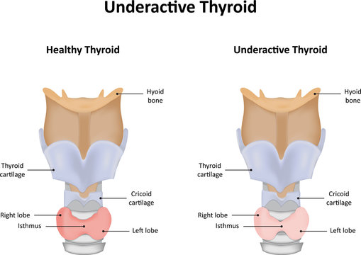 Underactive Thyroid