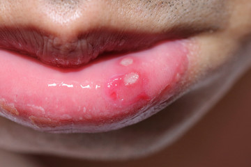 lip with aphthous stomatitis