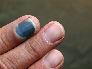 Fingerquetschung