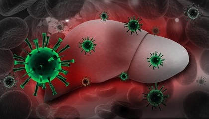 Liver Infection with hepatitis viruses.