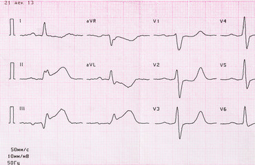 Tape ECG with acute period of myocardial infarction