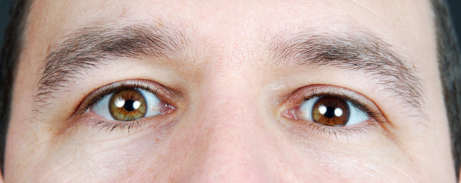 Heterochromia Iridum