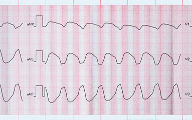 ECG tape with paroxysmal ventricular tachycardia