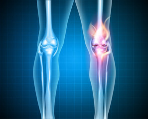 Burning knee, painful knee and normal knee joint, abstract desig