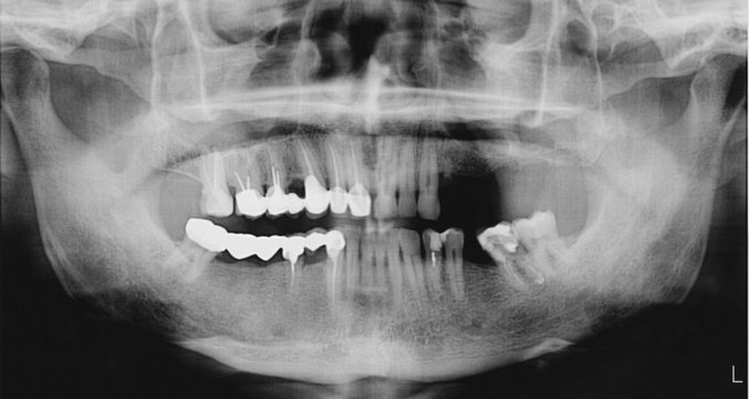 Panoramic x-ray of the mouth