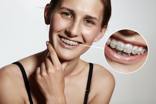 prety girl is smiling with braces and lens showing them bigger