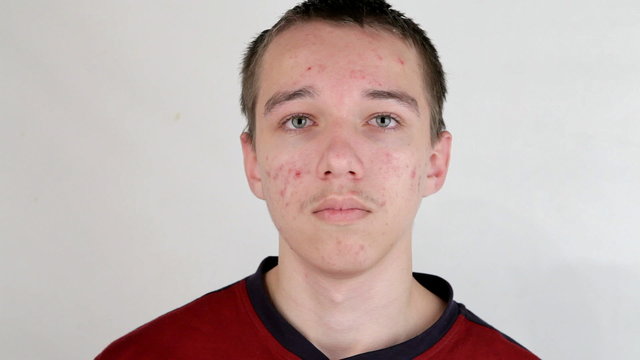 Teenage boy with puberty acne problem