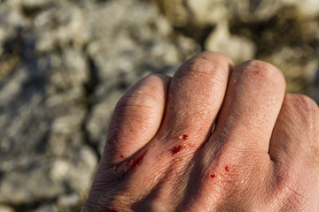 Bloody wound on his left hand