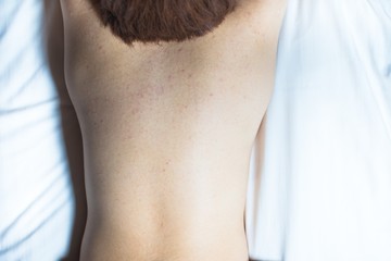 肌荒れの女性