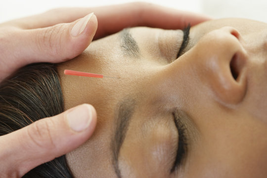 Acupuncture needle in African woman's forehead