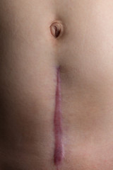 Recovering C-Section Scar