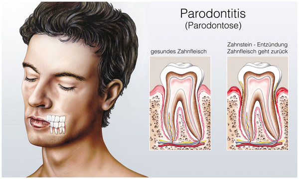 Parodontitis.Parodontose.Zahnfleisch
