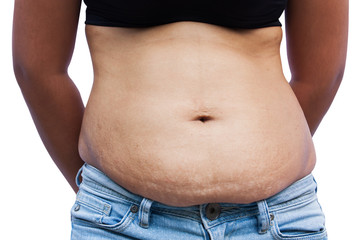 Naklejka premium Women body with fat belly and stretch marks,front view