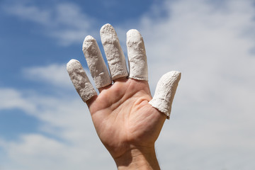 Hand vor blauem Himmel, eingegipste Finger