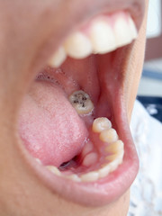 Human teeth with cavity needing treatment 