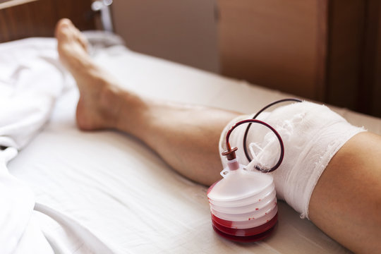 Дренаж после операции фото как выглядит Blood Container Images - Browse 303 Stock Photos, Vectors, and Video Adobe Stock