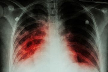 Pulmonary Tuberculosis (TB) : Chest x-ray 
