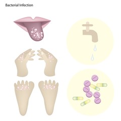 Bacterial Infection with Disease Prevention and Treatment
