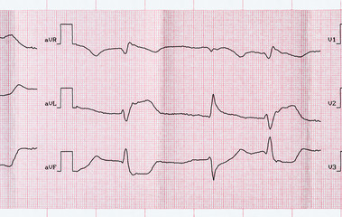  ECG with acute period macrofocal myocardial infarction 
