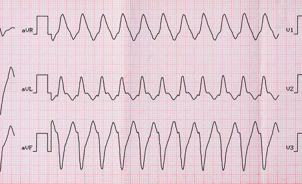 ECG With Paroxysm Correct Form Of Atrial Flutter 