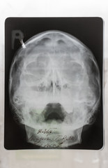 Child Skull X-Ray