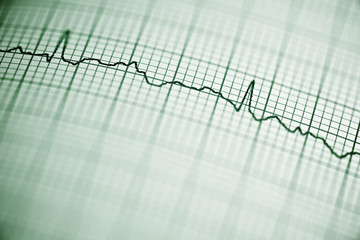 Electrocardiogram