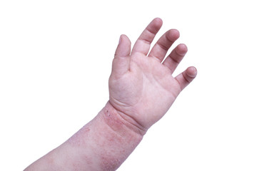 Eczema on the kid's hand