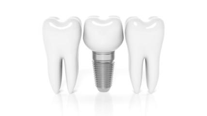 Row of teeth with dental implant isolated on white background