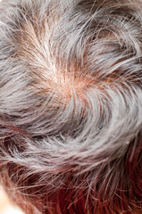 Human alopecia or hair loss problem and grizzly