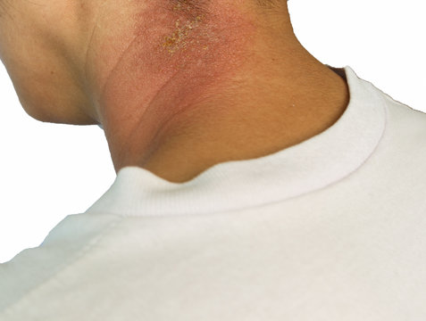 Rash On Neck Isolated On White Background