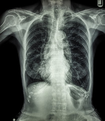 Chest X-ray of old patient