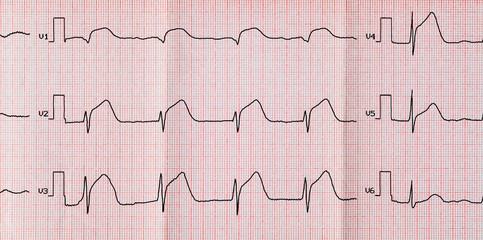 ECG with acute period macrofocal widespread anterior myocardial