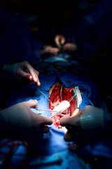 Teamwork surgeons during open-heart surgery