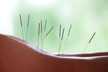 Close-up of a woman with Acupuncture needles in her back