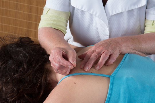 Girl receiving an acupuncture treatment in a health spa