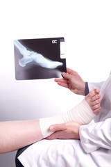 Doctor exam one X-ray picture of sprained foot - obrazy, fototapety, plakaty