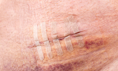 Close-up of a fresh scar or operating wound