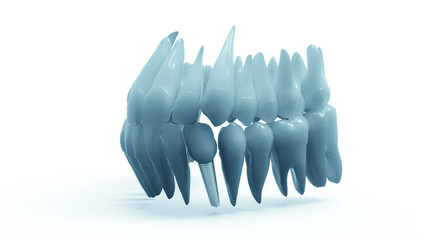 Dental implant on white background