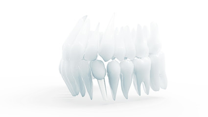 Dental implant on white background - obrazy, fototapety, plakaty