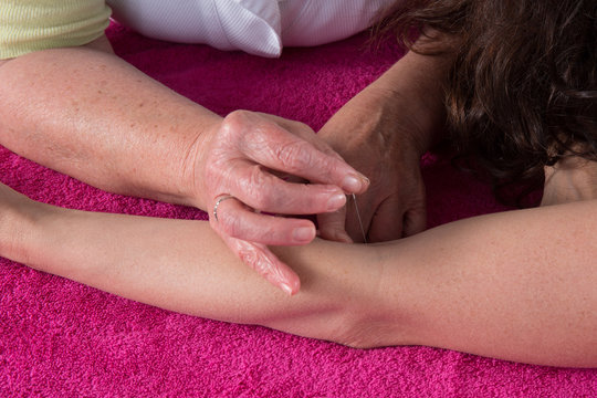 Detail of acupuncturist placing a needle in hand of the patient