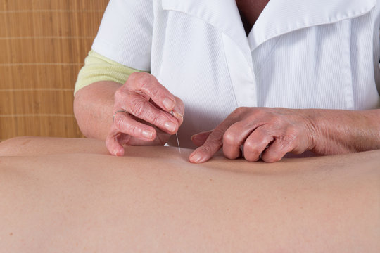 Acupuncturist prepares to tap needle into patients skin