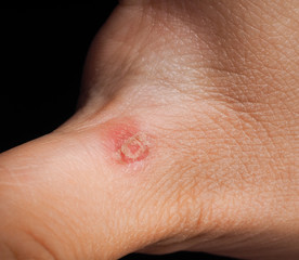 Fototapeta premium Closeup of injury on hand below thumb isolated towards black bac