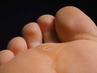 Closeup of foot with a infected wart placed under toes, isolated - obrazy, fototapety, plakaty