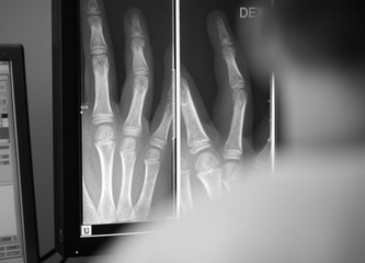 Digital x-ray of a patient hand